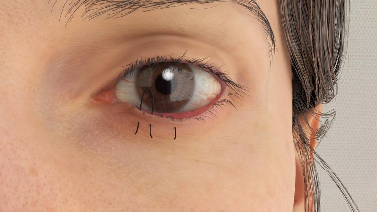 Entropion Repair - Everting Sutures (Quickert Sutures)