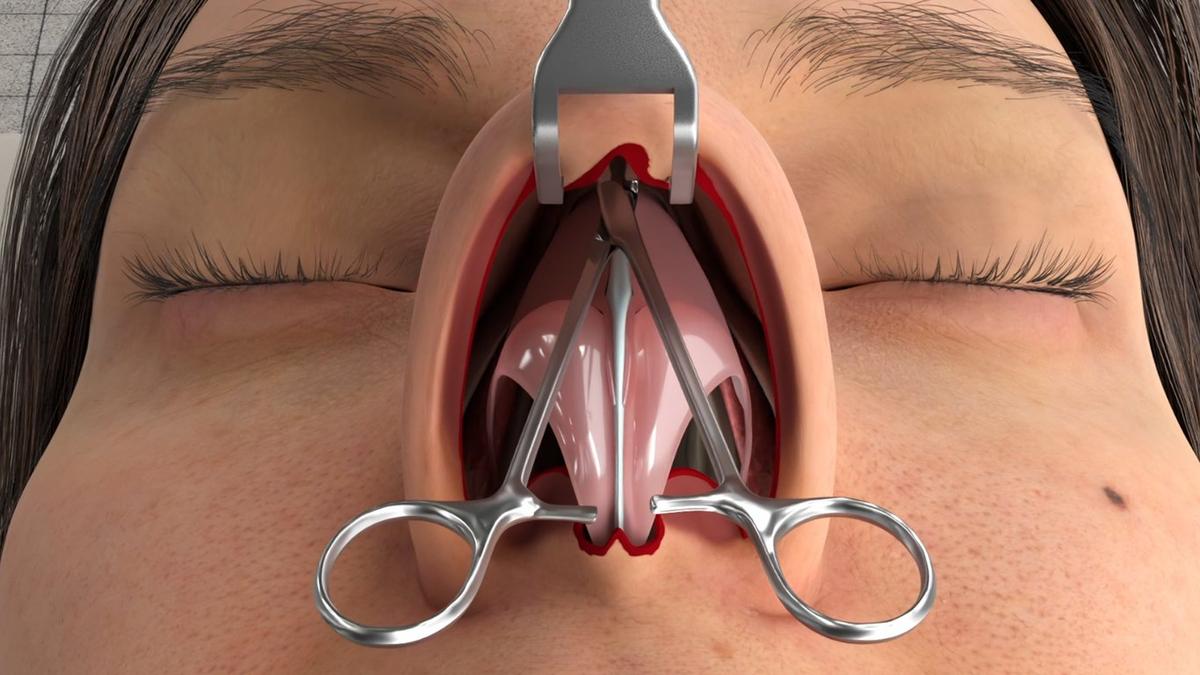 Open Rhinoplasty (External Approach)
