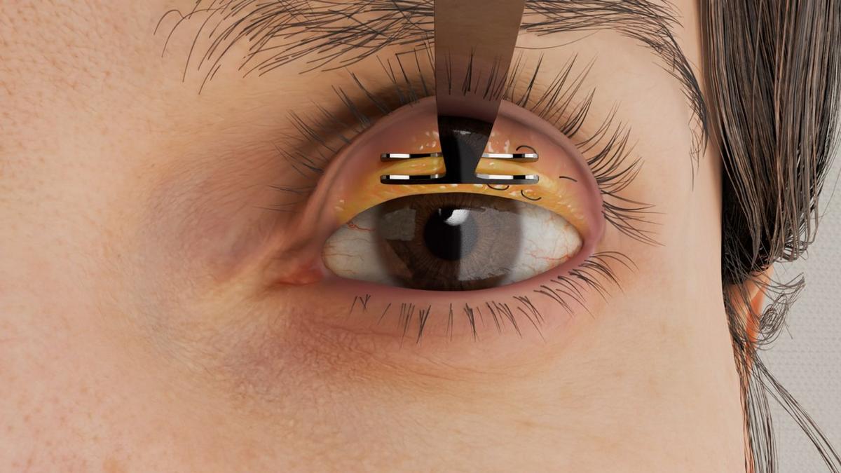 Ptosis Repair – Müllerectomy