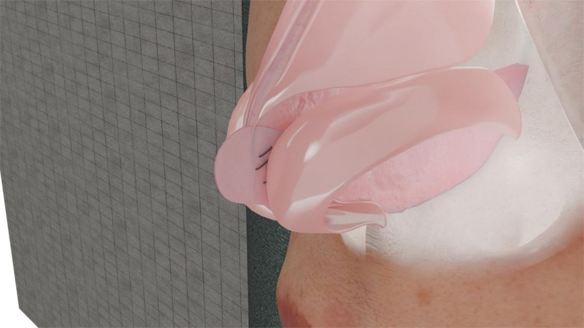 Septal Extension Graft