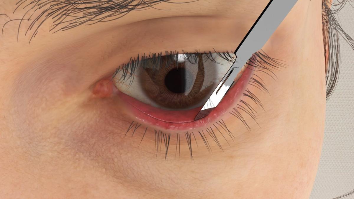 Lower Blepharoplasty – Transconjunctival Approach
