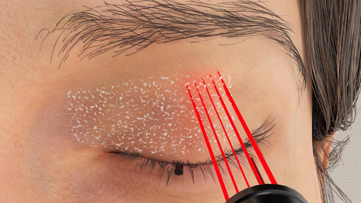 Upper Blepharoplasty – CO2 Laser Tightening