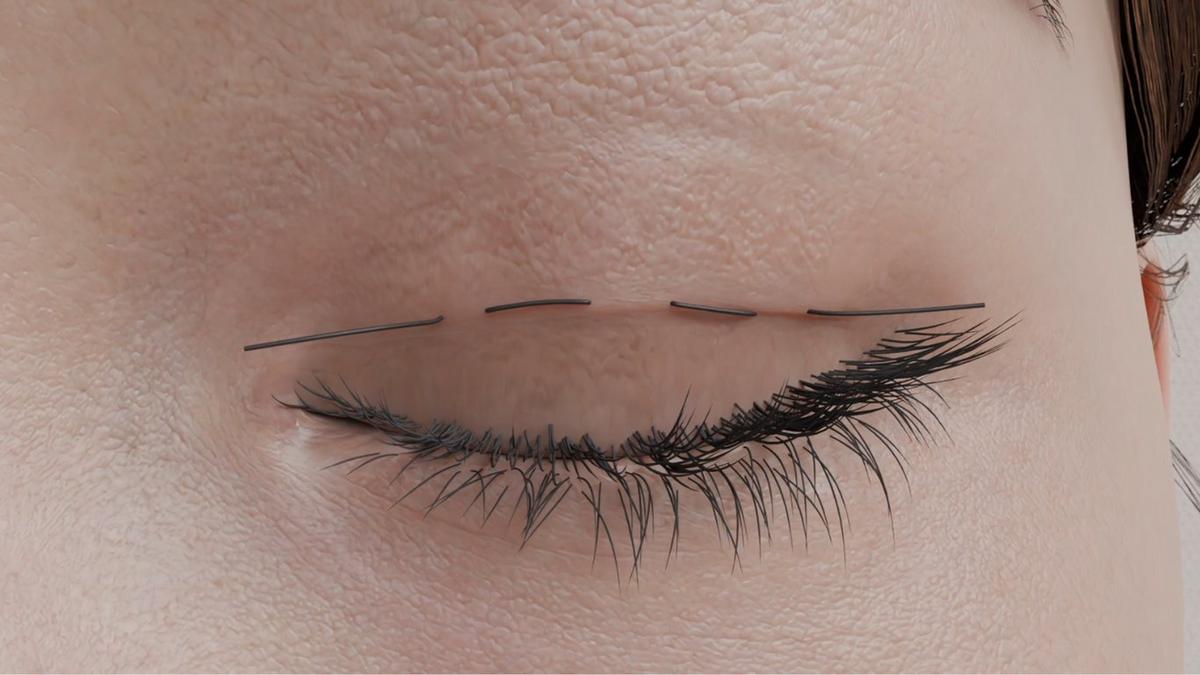 Asian Double Eyelid Surgery – Suture (Non-Incisional) Technique