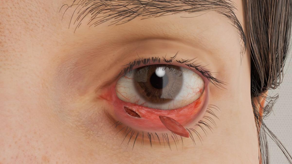 Ectropion Repair - Medial Spindle Technique