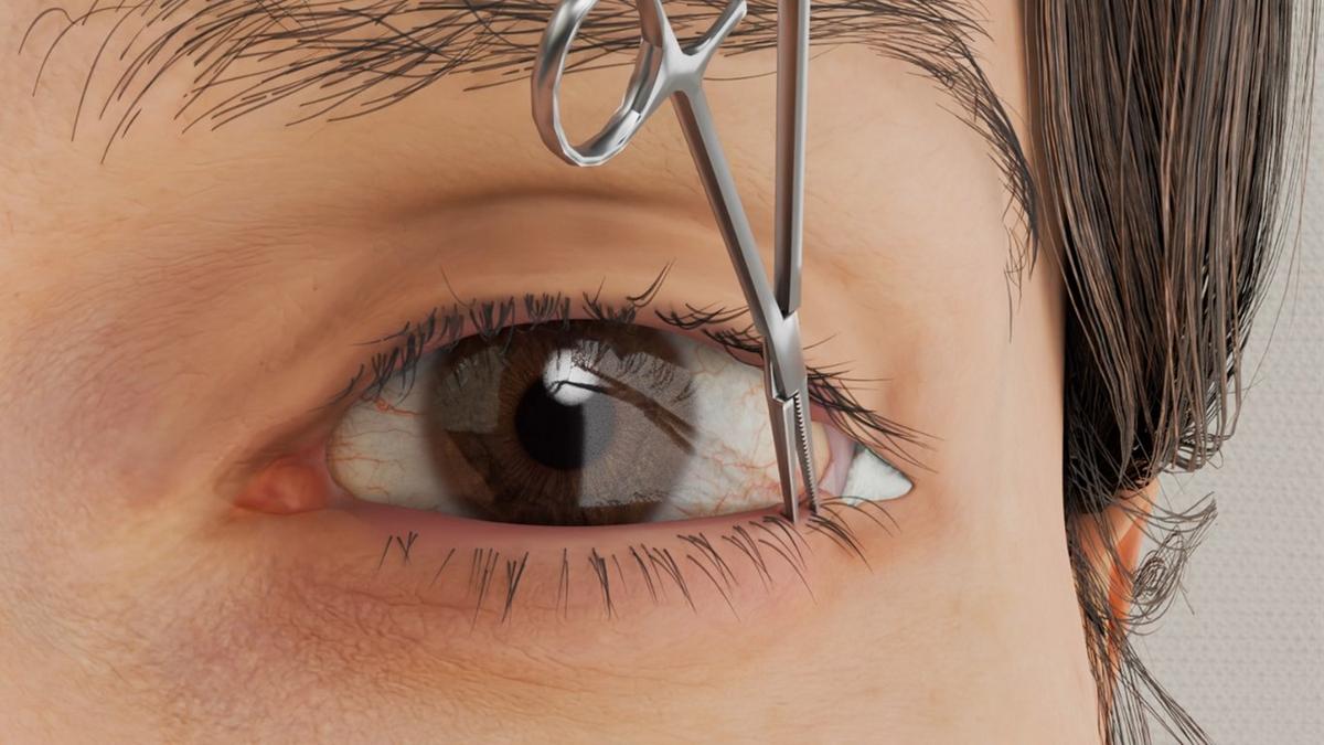 Entropion Repair - Lateral Tarsal Strip