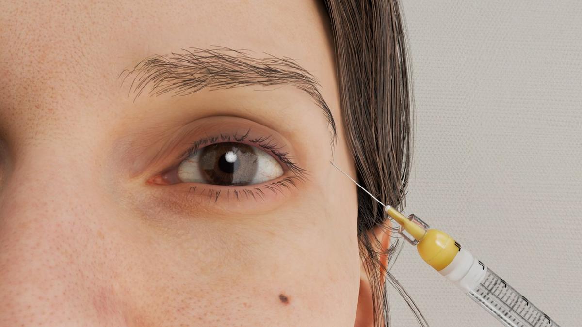 Periorbital Fat Transfer