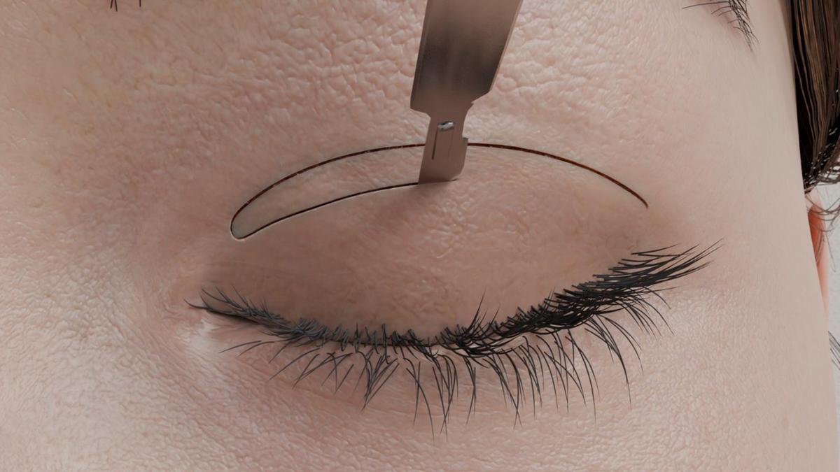 Asian Double Eyelid Surgery – Incisional Technique