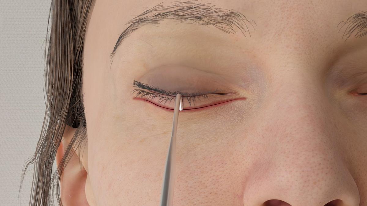 Tear Trough Implant - Subciliary Approach (External Incision)