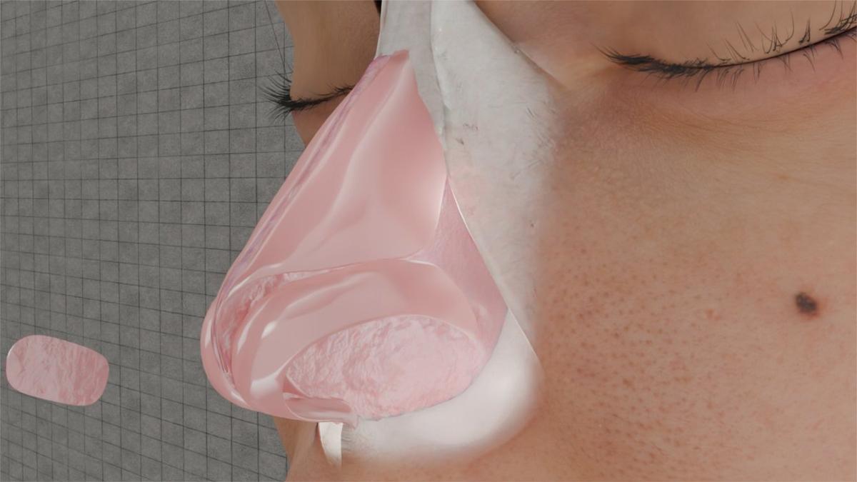 Columellar Strut Graft