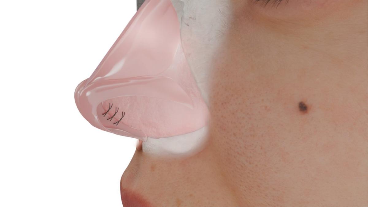 Tongue-in-Groove (Tip Support Technique)