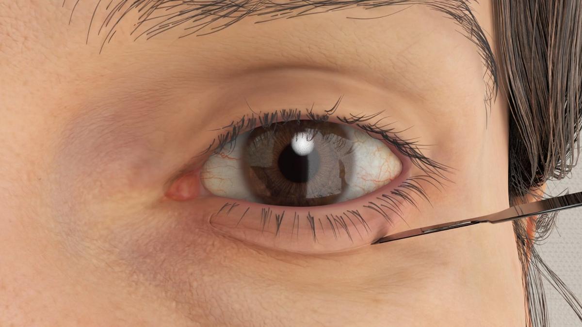 Lower Blepharoplasty – Skin Pinch Technique